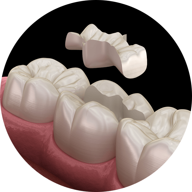 dental inlay graphic