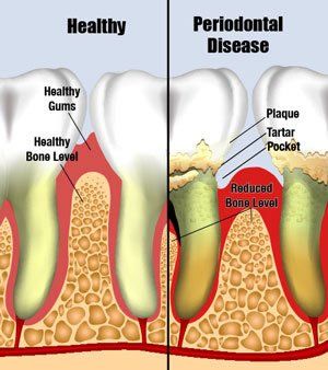 Deep Teeth Cleaning Orange Ca - Dental Scaling and Root Planing Near Me -  Orange Coast Cosmetic Dentistry
