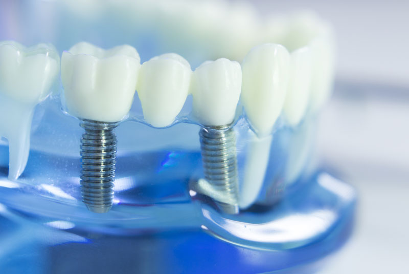 a model of two placed zirconia dental implants