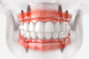 a digital model of full arch dental implants and posts.