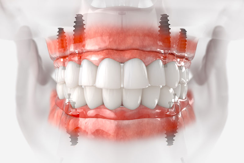 a digital model of full arch dental implants and posts.