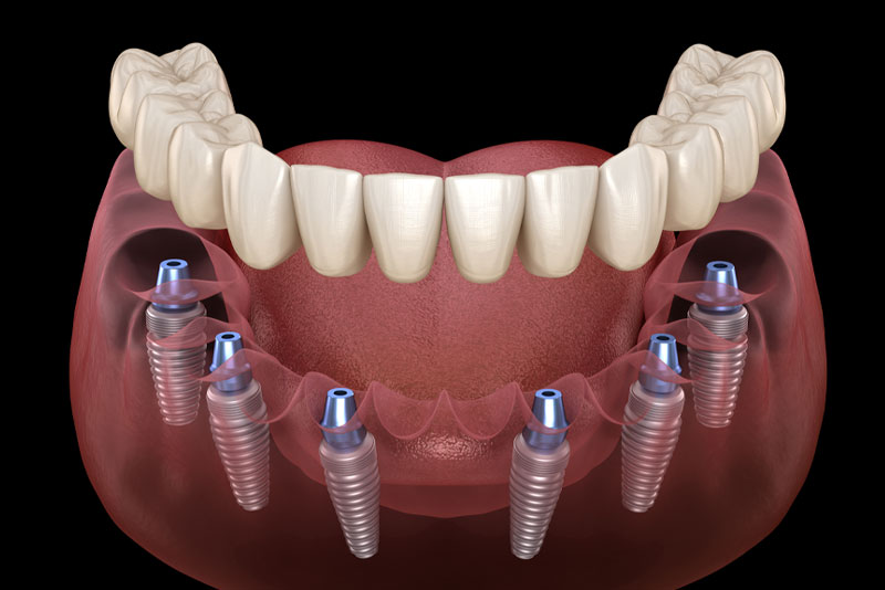 an image of a full mouth dental implant model to show a patient how dental implants will be placed in their jaw for their TeethXpress treatment.