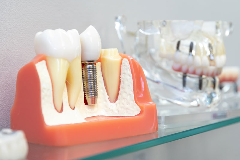 a picture of a dental implant model showing what the gum line looks like with a single dental implant, one of the dental implant options, that has a dental implant post, abutment, and prosthetic placed in it.