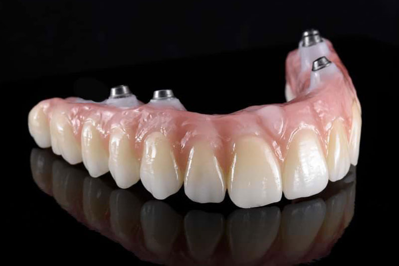 a picture of a zirconia bridge for the upper arch that has four dental implants in them for a zirconia fixed bridge procedure.