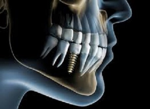 x-ray of dental implant in mouth
