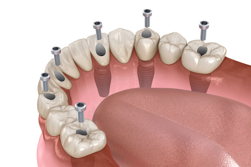 a full mouth dental implant model for the lower arch that shows dental implants securing a prosthesis so people learn how there are more advantages to getting treated with full mouth dental implants than traditional dentures.