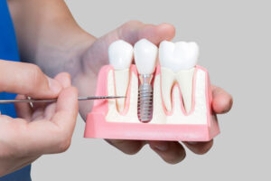 a dentist holding a jawbone cutaway model showing a single dental implant post and crown prosthetic.