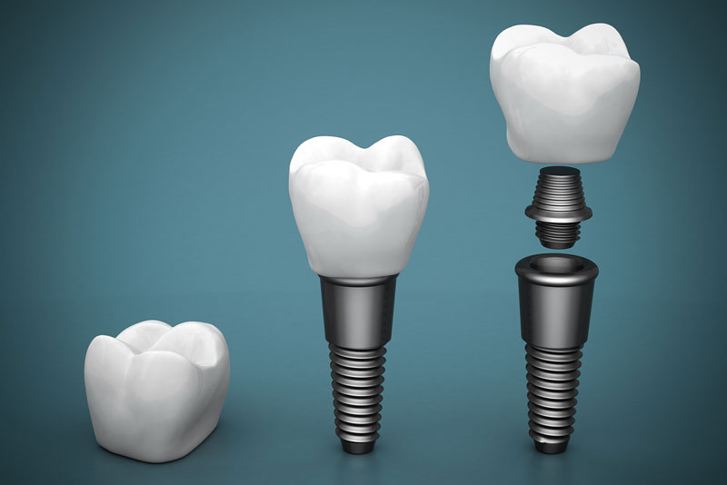 a digital model showing the dental implant post, abutment, and crown.