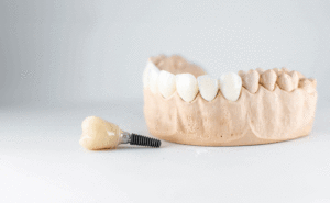 Dental implant in front of lower mouth model.