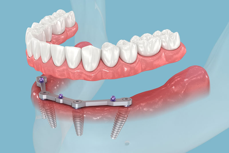 3D model of a lower dental implant with artificial teeth supported by four implants and a metal bar